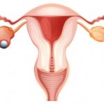 Vektorgrafik einer Gebährmutter mit Eierstöcken, bei welchem einer von Krebs befallen ist.